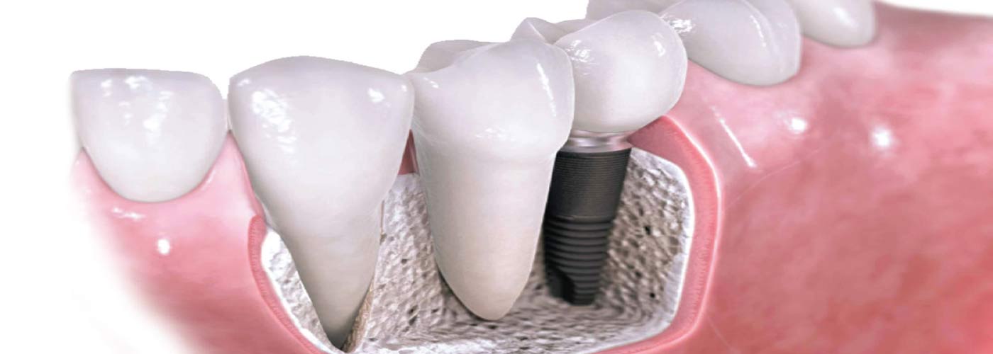 Zubni implanti Beograd | Ugradnja veštačke kosti
