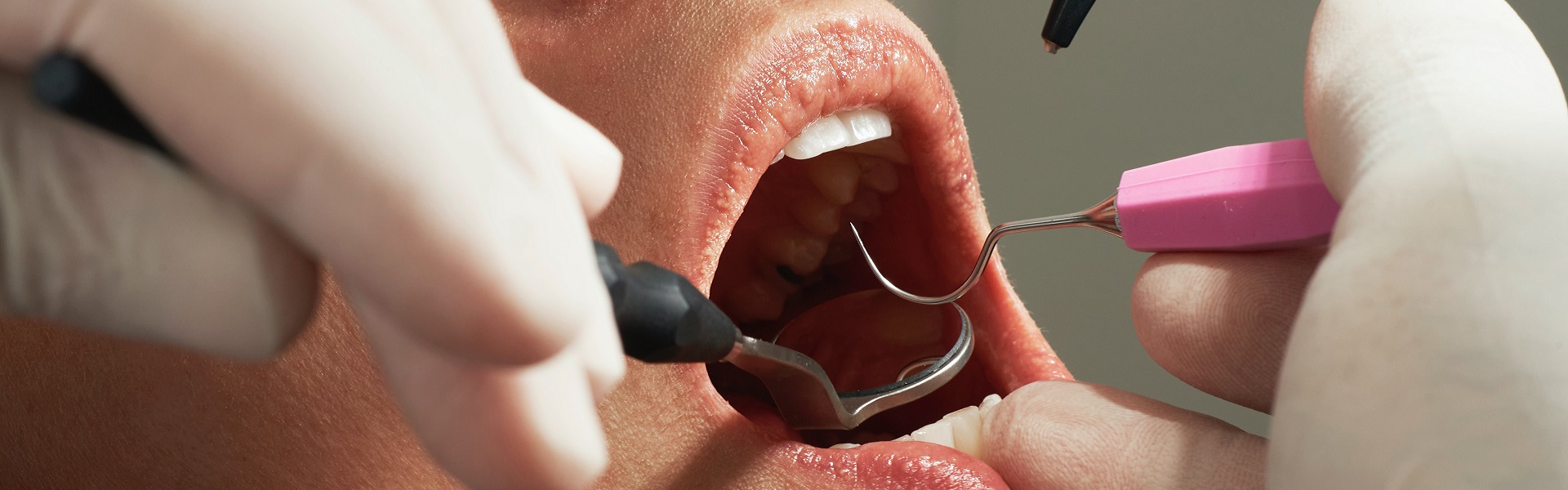 Zubni Implanti Beograd | Stomatolog Kragujevac